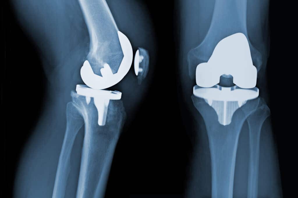X-ray of knee implant