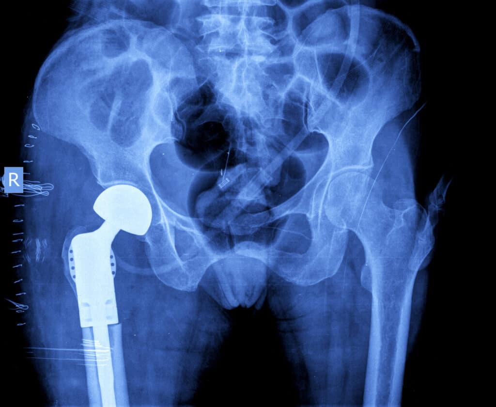 X-ray of a hip replacement device