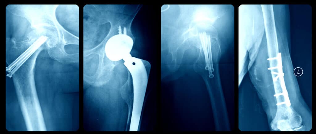 X-rays of joint replacements