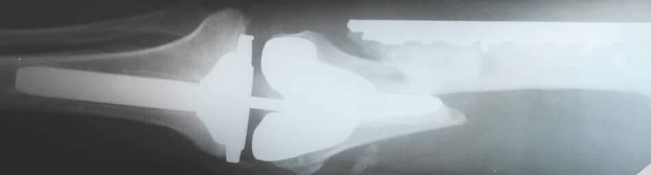 x-ray of broken thigh bone
