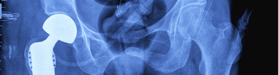 X-ray of hip with a hip replacement