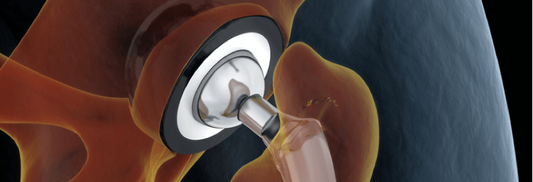 3D illustration of the hip replacement