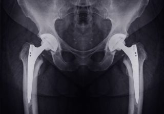 X-ray of hip implants.
