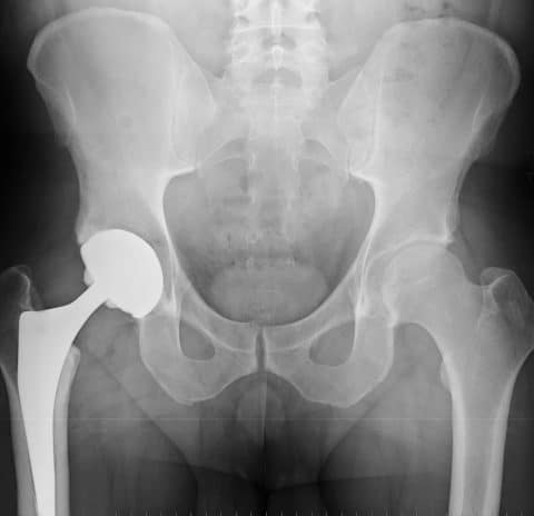 Hip implant X-ray.