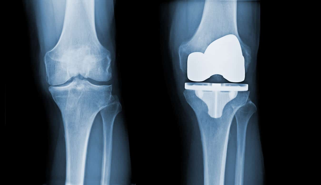 knee-replacement-xray
