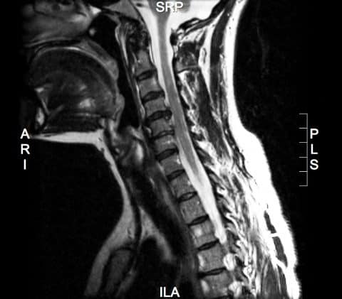 Spinal cord injuries cause paralysis