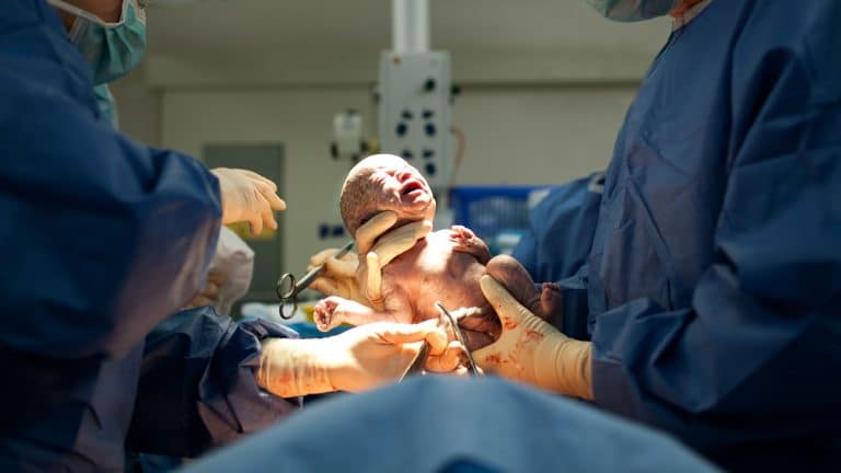 Negligence during delivery may result in cerebral palsy.