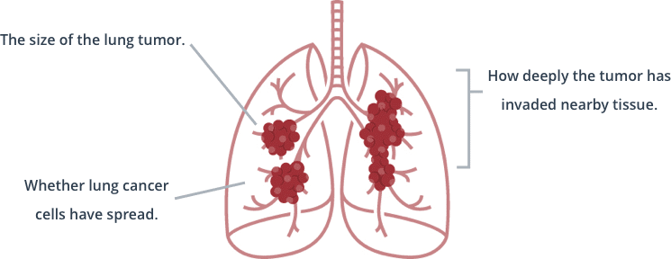 The stage or progression of lung cancer is determined by the size of the lung tumor, how deeply the tumor has invaded nearby tissue, and whether lung cancer cells have spread.